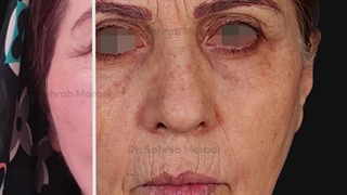 لیفت صورت و گردن و جراحی پلک پایین-بهترین جراح لیفت صورت