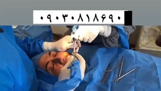 ایمپلنت سوییسی