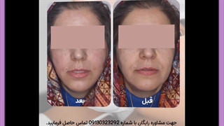 لیفت صورت با نخ سیلوئت