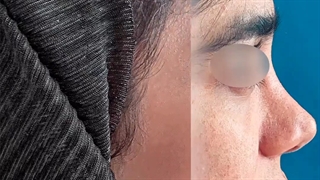 سانترال لب و لیفت شقیقه | دکتر علی الستی