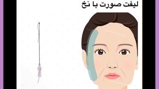 لیفت صورت با نخ چیه