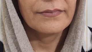 فیلر لب و خط خنده لیفت ابرو