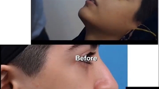 باز کردن گچ بینی | دکتر محمد مهدی سالم