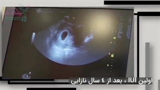 بارداری با IUI بعد از چهار سال نازایی