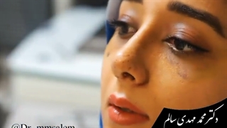 بلافاصله بعد از برداشتن اسپیلنت بینی | دکتر محمد مهدی سالم کلینیک زیبایی