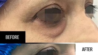 بلفاروپلاستی پلک پایین - دکتر علی الستی