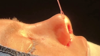 جراحی بینی گوشتی با پره های بزرگ