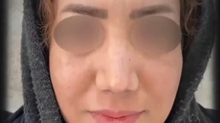 عمل بینی استخوانی