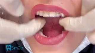 ارتودنسی نامرئی