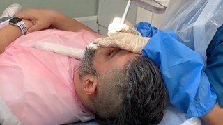 بلیچینگ دندان | سفید کردن دندان لیفت صورت