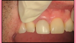 همه سوالات در خصوص جراحی لثه پلاستیک لثه