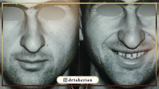 جراحی زیبایی بینی کج و گوشتی با افتادگی بسیار شدید