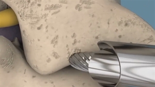 تفاوت جراحی آندوسکوپی دیسک با لیزر