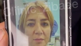 لیفت صورت و لیفت لب سانترال لب