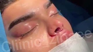 لیفت لب سانترال لب لیفت ابرو لیفت شقیقه