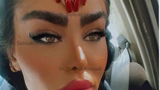 لیفت اندوسکوپی ابرو - بهترین جراح لیفت ابرو در تهران