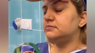 دو ماه بعد از عمل جراحی لیفت ابرو اندوسکوپیک