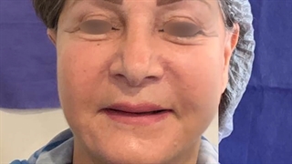 با لیفت صورت 10 سال جوان تر شوید | دکت علی الستی