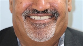 درمان بی دندانی کامل دوفک بیمار با کمک اوردنچر متکی بر ایمپلنت | دکتر محمد محمدی