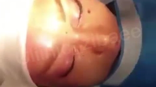 لیفت کل صورت (لیفت شقیقه و لیفت گونه و لیفت پیشانی)