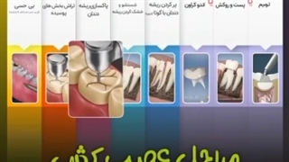مراحل عصب کشی دندان