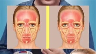 "رفع چین و چروک با مینی هایفو: روش غیرجراحی و بدون خونریزی با ماندگاری 6 ماه"