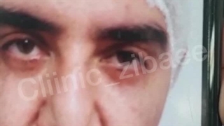 بهترین مرکز تزریق چربی سانترال لب پ بلفاروپلاستی در یوسف آباد