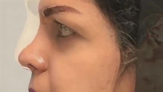 یک ماه و نیم پس ازجراحی زیبایی بینی