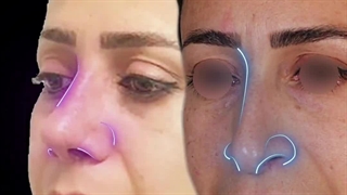 قبل و یک ماه بعد از جراحی زیبایی بینی