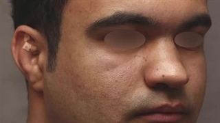 قبل و بعد از جراحی ترمیمی بینی