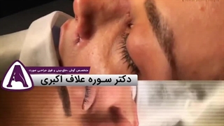 قبل از جراحی بینی و بلافاصله بعد از جراحی