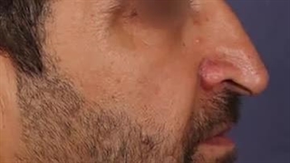 ۴ ماه بعد از جراحی بینی کج و بزرگ ✨