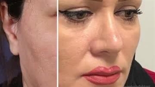 عمل پلک بالا