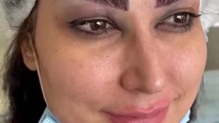 کاشت ابروی طبیعی