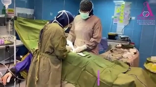 سزارین شکم اول