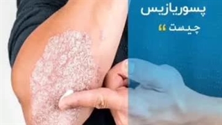 درمان پسوریازیس با قهوه گانودرما