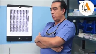 درمان تنگی کانال نخاعی