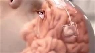 مقایسه مغز بیمار جوان و بیمار مسن 