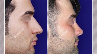 جراحی زیبایی بینی مردانه و طبیعی