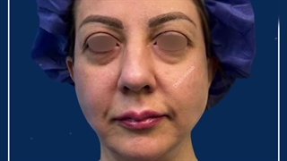لیفت صورت و گردن و جراحی پلک پایین