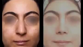 جراحی بینی گوشتی