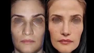 جراحی بینی گوشتی