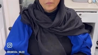 آموزش ریموو تاتو ابرو با تکنیک تخصصی