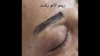 برداشتن اپیدرم در ریمو تاتو