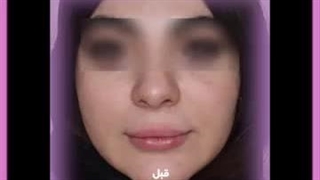 مراقبت های بعد از تزریق ژل رفع افتادگی پلک