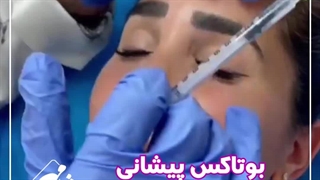 تزریق بوتاکس پیشانی در مرکز زیبایی شادمهر