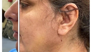 رفع غبغب با اندولیفت