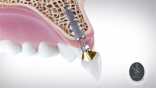 انیمیشن ایمپلنت گذاری دندان