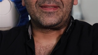 لبخند رضایت آقای فیضی رفع افتادگی پلک