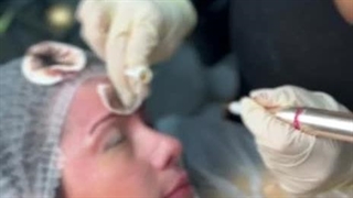 ریموو تاتو با بروزترین تکنیک در مرکز تخصصی نیلوفر کاظمی